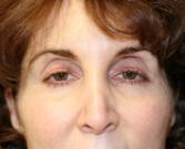 Feel Beautiful - Eyelid Surgery San Diego 53 - Before Photo